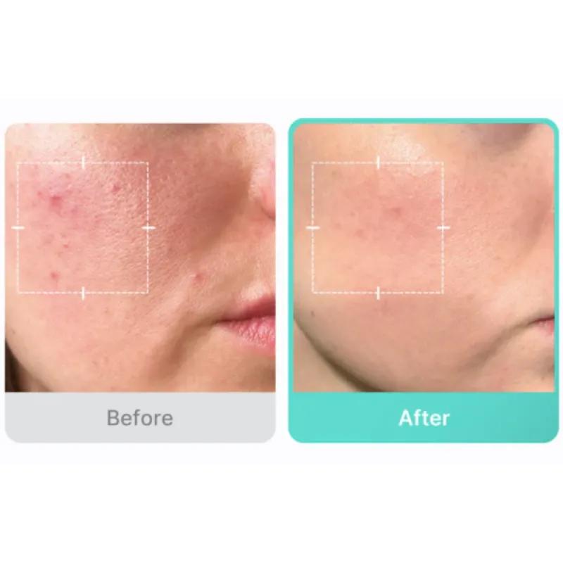Успокаивающая сыворотка с азелаиновой кислотой 16% Medicube Azelaic Acid 16 BB Calming Serum 30 ml