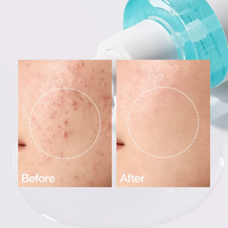 Відлущувальний тонер з саліциловою кислотою 2% Anua BHA 2% Gentle Toner 150 ml