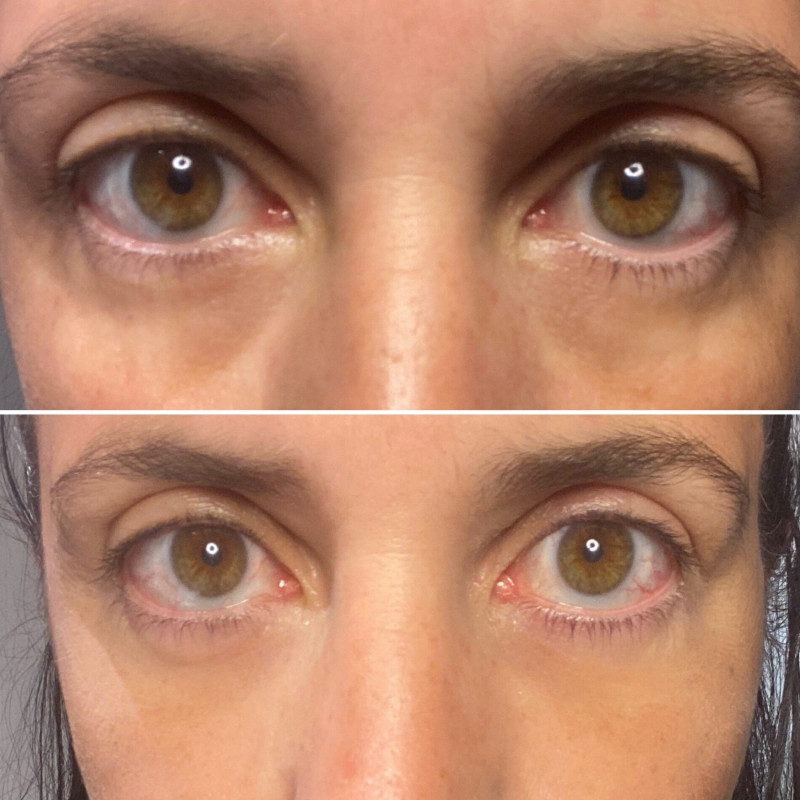 Крем для разглаживания кожи вокруг глаз Peter Thomas Roth Instant FIRMx® Eye Temporary Eye Tightener 15 ml