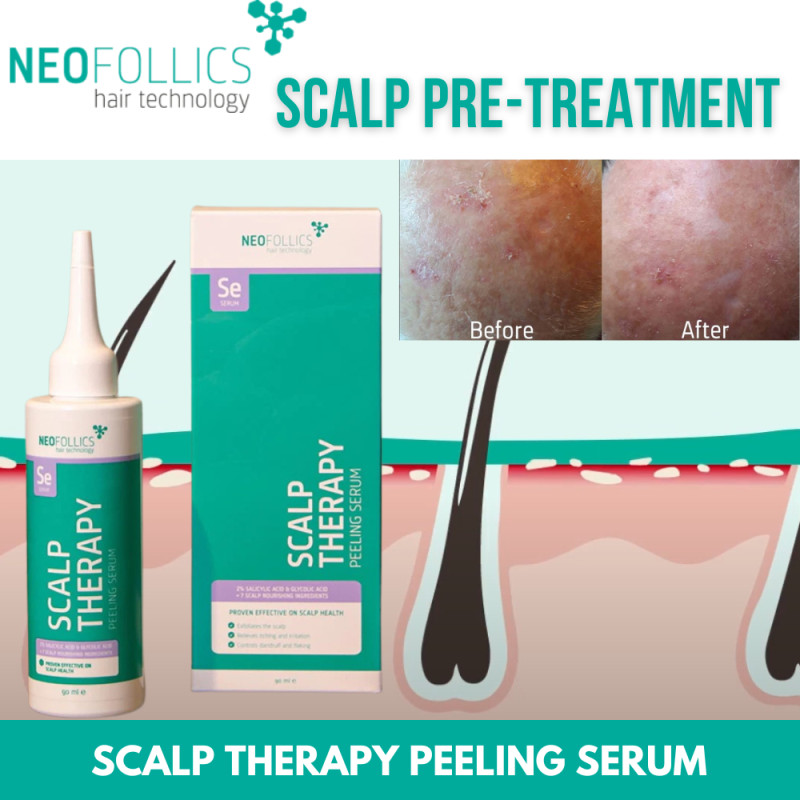 Отшелушивающая сыворотка для кожи головы Neofollics Hair Technology Neofollics Scalp Therapy Peeling Serum 90 ml
